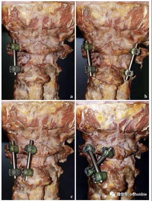 c1后弓钉置入法:后弓结节两旁4-5mm,顺后弓皮质钻入,钉道位于后弓骨质