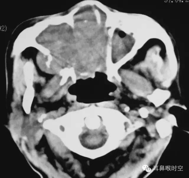 上颌窦癌ct表现:副鼻窦良性与恶性肿瘤的比为1:3.