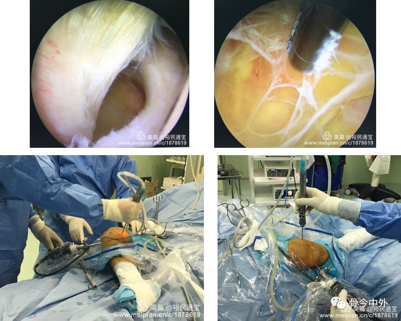 手術全過程關節鏡四字位雙後內入路治療膕窩囊腫