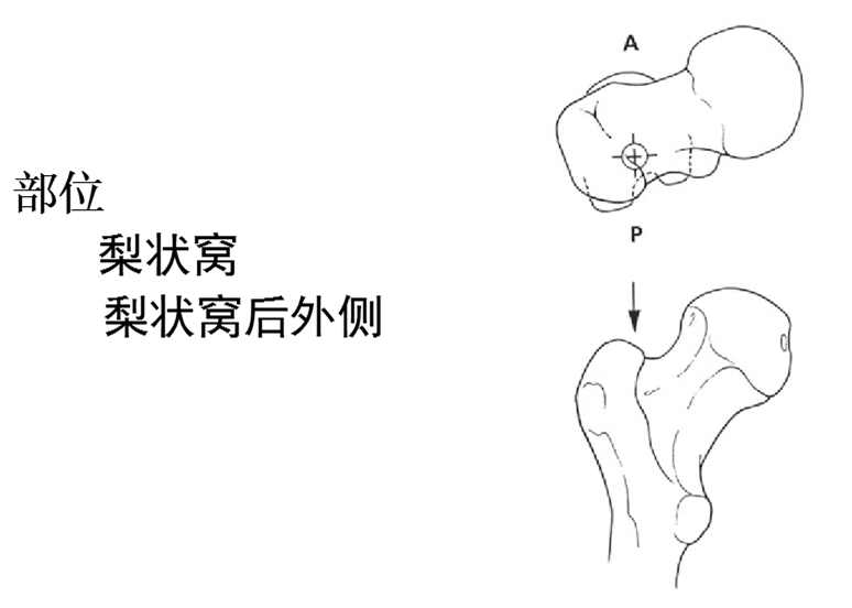 5种髓内钉应用原则及手术技术100干货