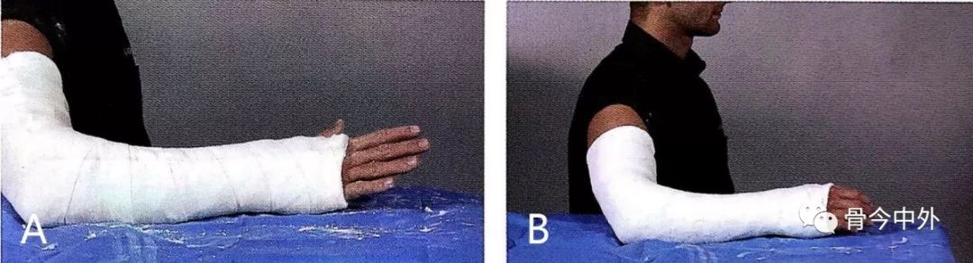 使用医用剪刀剪开棉垫和管状绷带以完成石膏管型劈开;c.